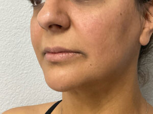Dermal Fillers