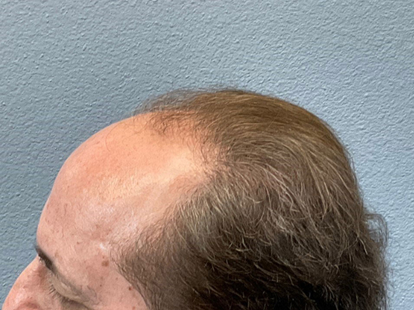 Hair Transplant