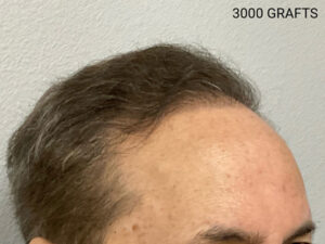 Hair Transplant