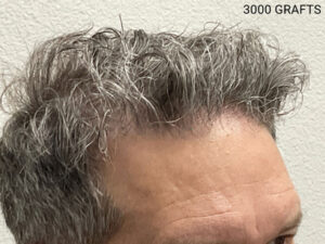 Hair Transplant