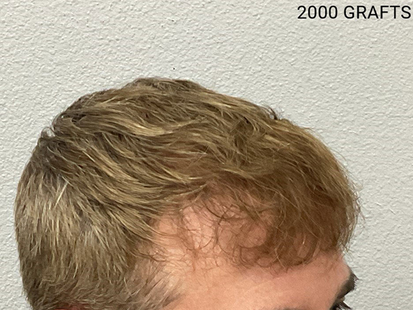 Hair Transplant
