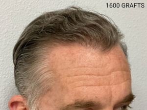 Hair Transplant