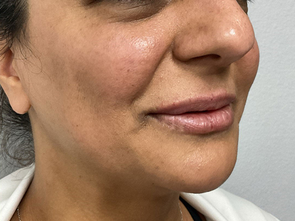 Dermal Fillers