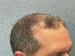 Hair Transplant