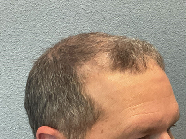 Hair Transplant