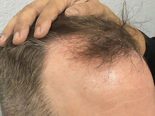 Hair Transplant