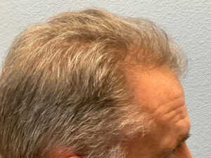 Hair Transplant