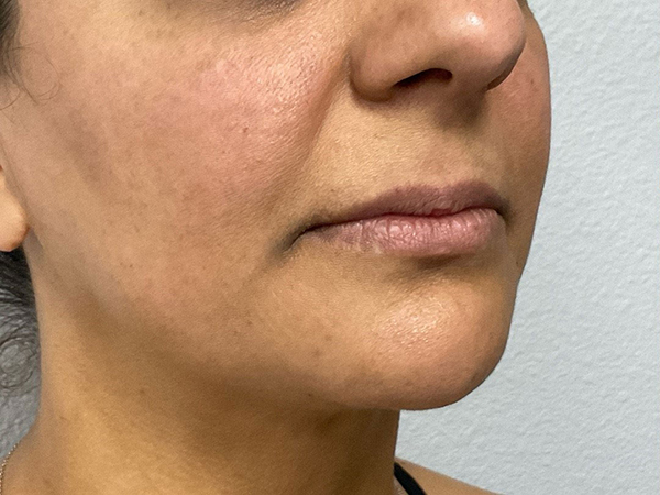 Dermal Fillers
