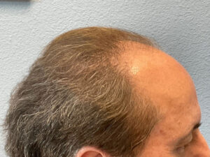 Hair Transplant